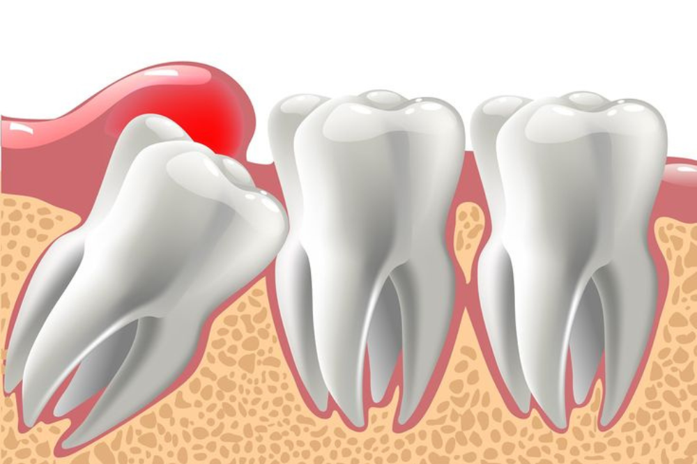 tooth-decay-in-wisdom-tooth-and-second-molar-leading-to-wisdom-tooth-pain-in-noida