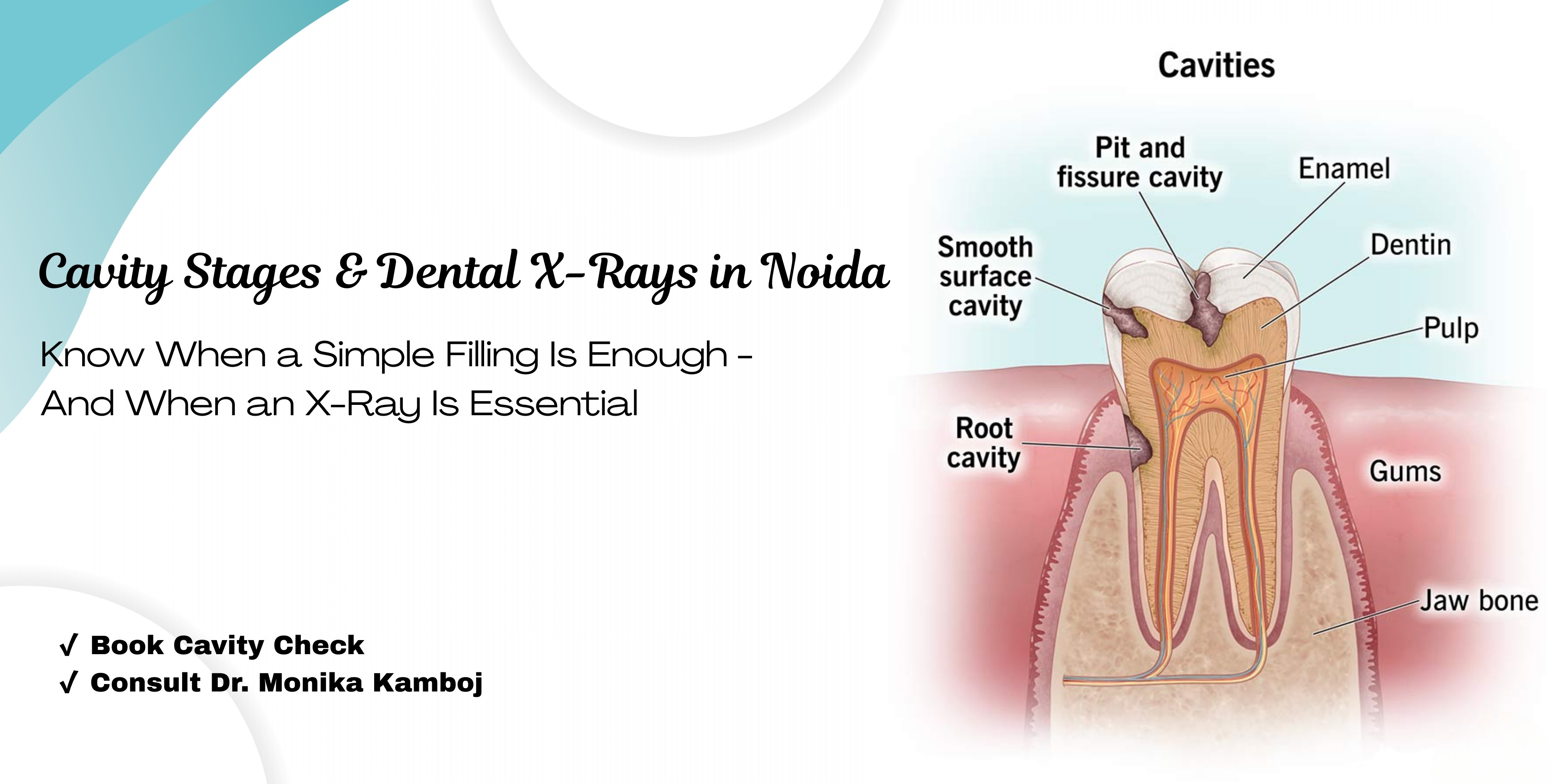 cavity-stages-showing-enamel-dentin-pulp-and-when-dental-x-rays-are-needed-before-fillings-in-noida-clinic