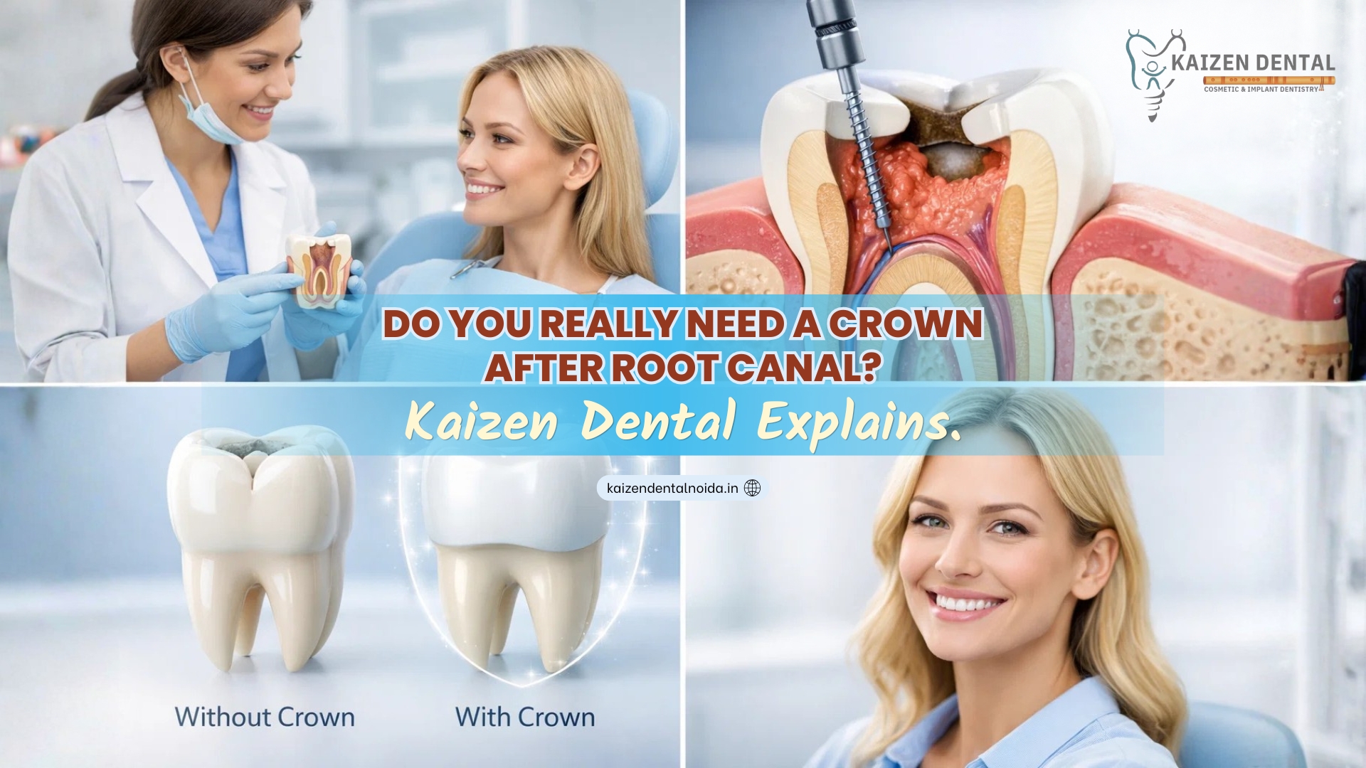 crown-after-root-canal-noida-kaizen-dental-sector-50-tooth-restoration