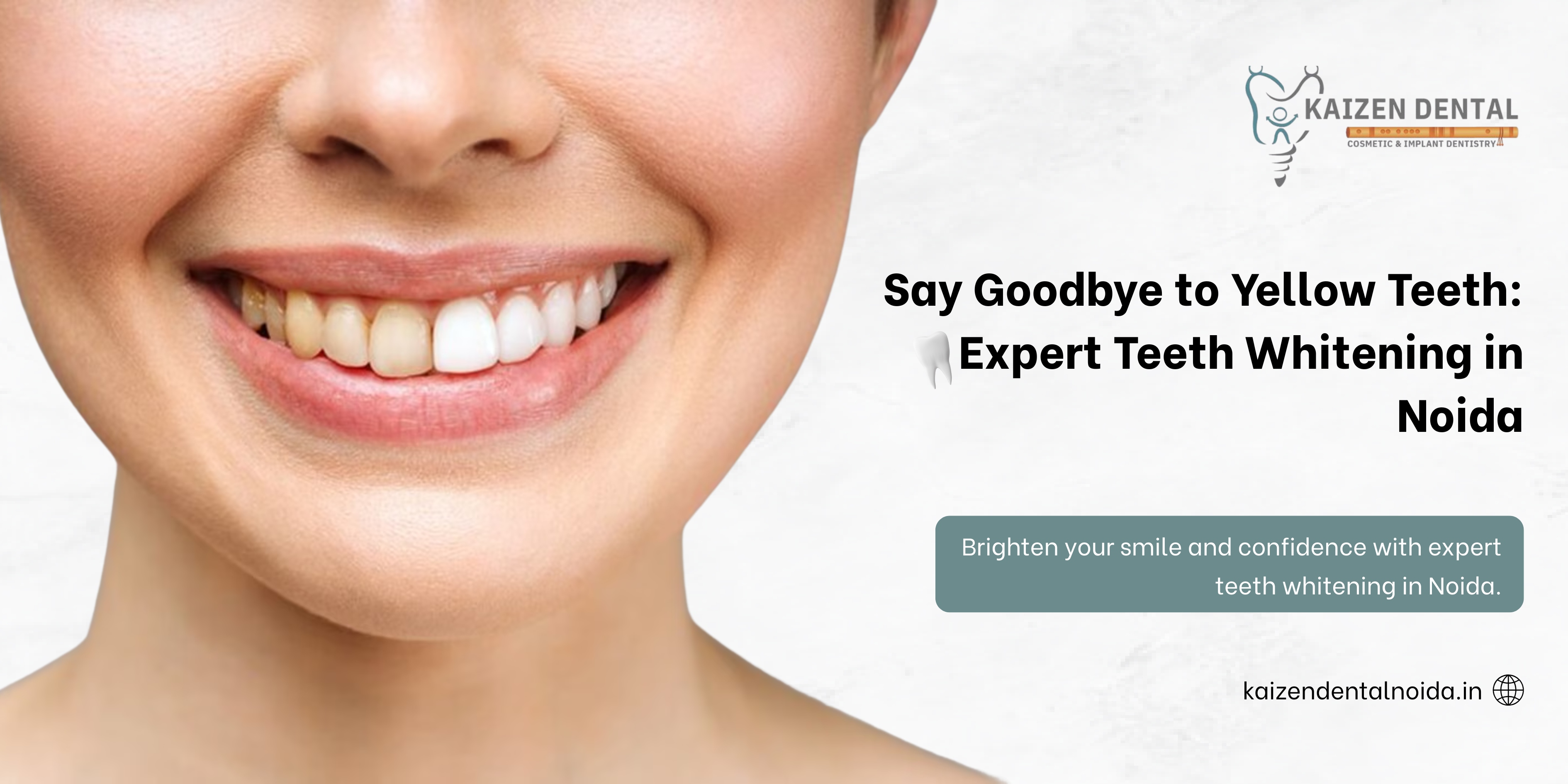 Teeth-whitening-in-Noida-Kaizen-Dental-before-after-bright-smile-transformation-Sector-50