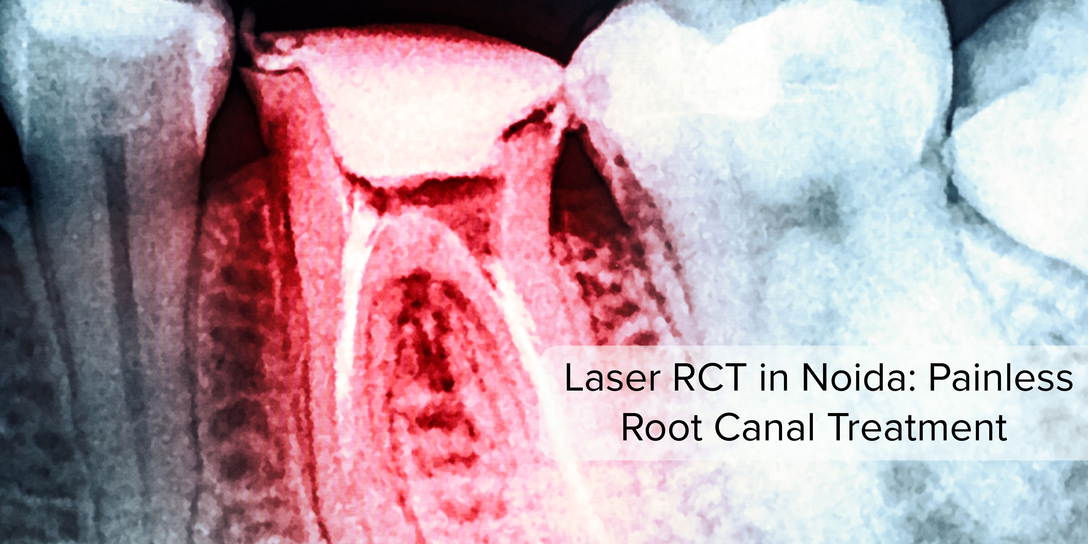 laser-assisted-root-canal-treatment-in-noida-at-kaizen-dental-for-pain-free-care