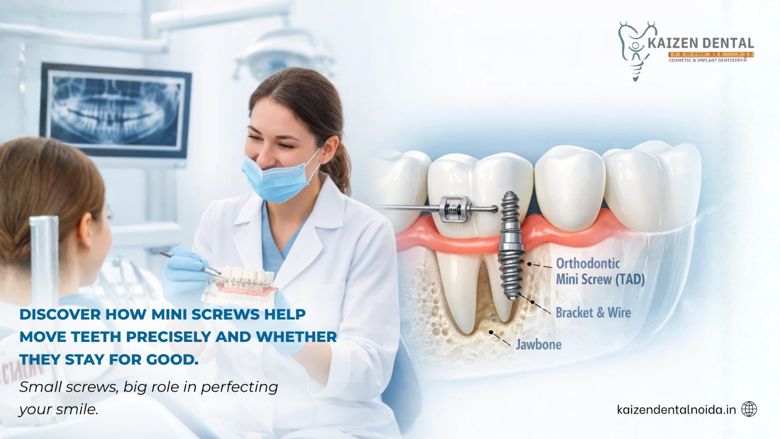 orthodontic-mini-screws-noida-tads-kaizen-dental-sector-50-braces