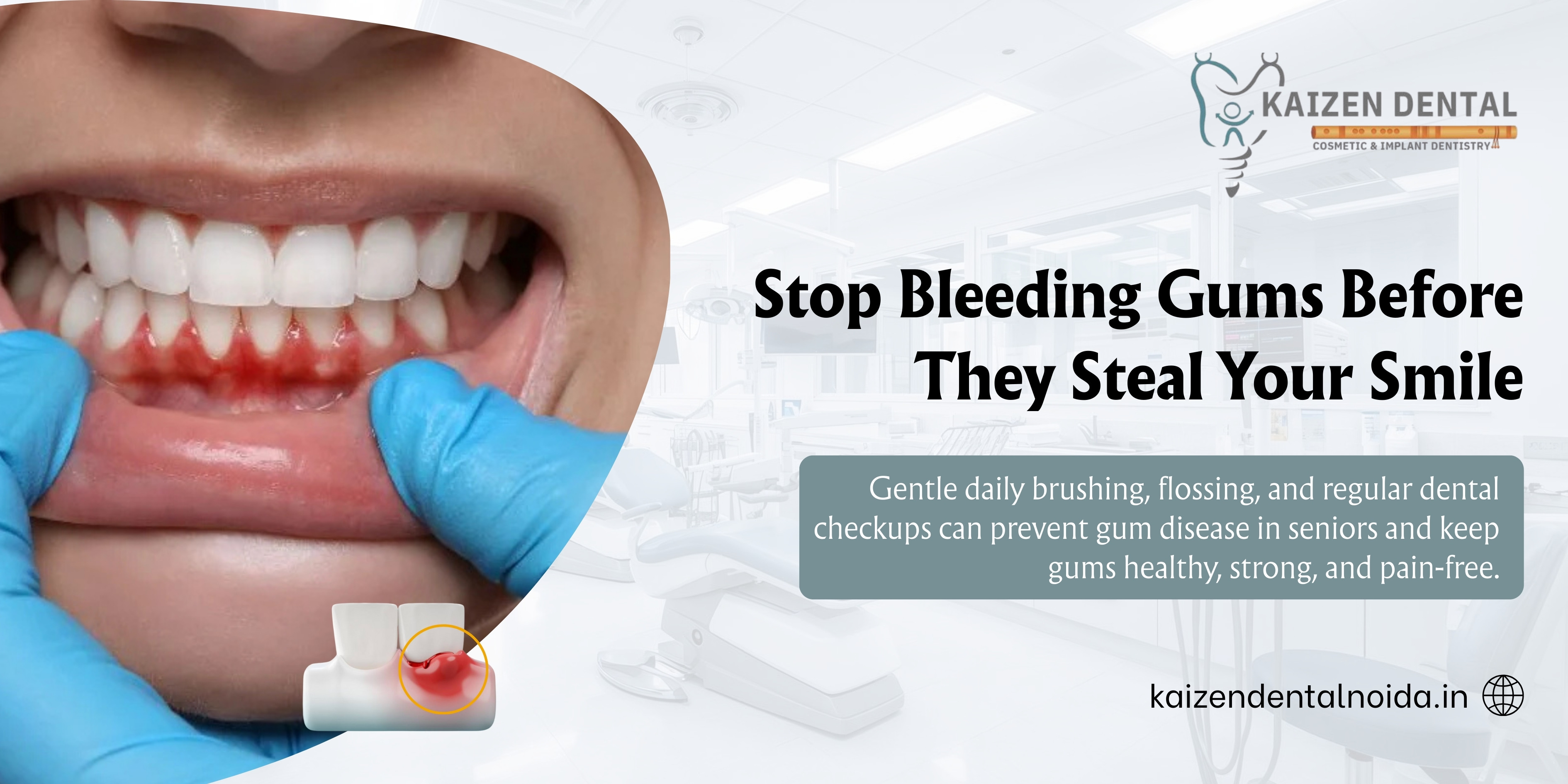 prevent-gum-disease-seniors-bleeding-gums-best-dentist-near-Sector-51-Noida-Kaizen-Dental-Sector-50