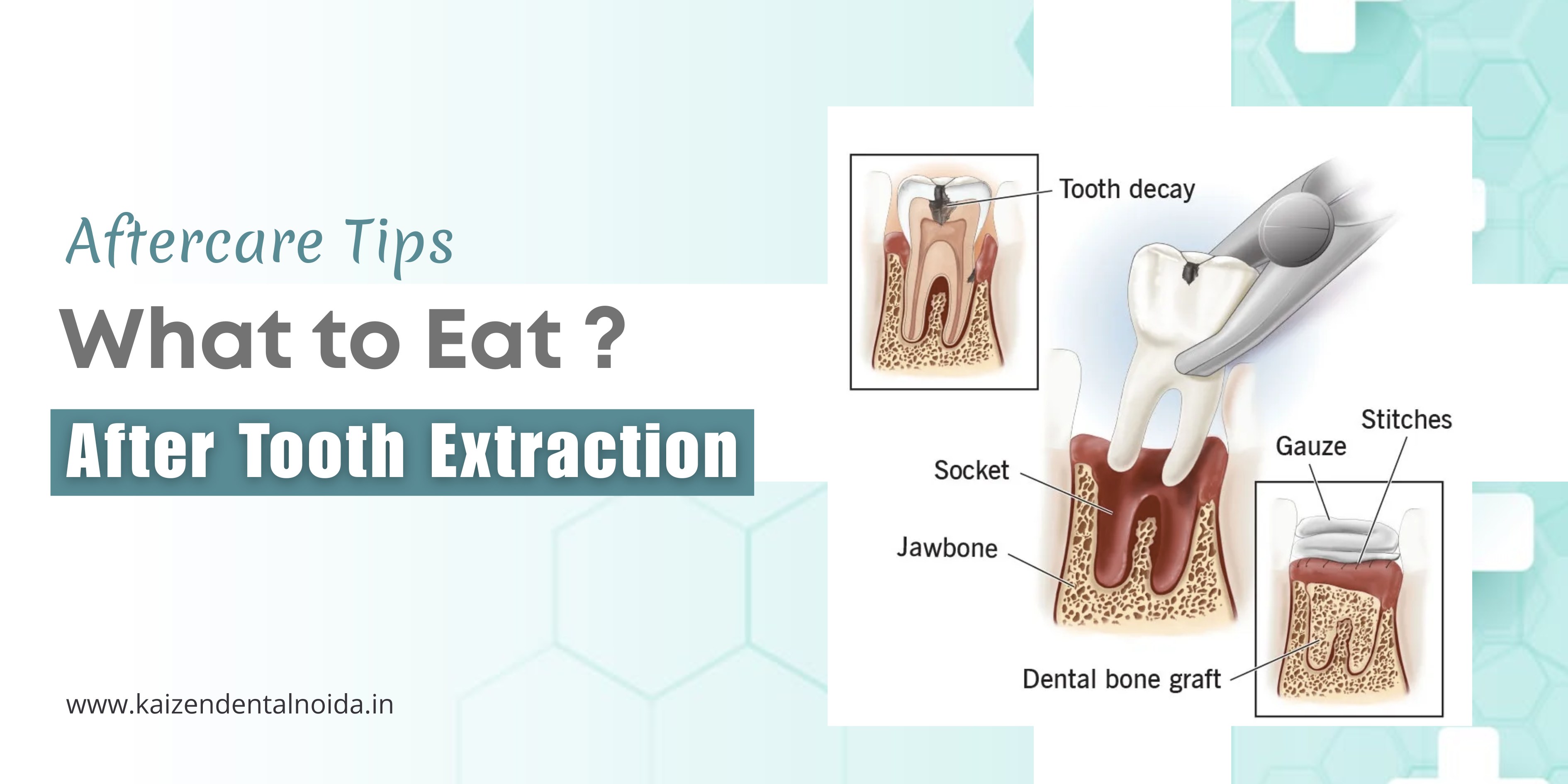 tooth-extraction-aftercare-soft-foods-recovery-guide-Noida