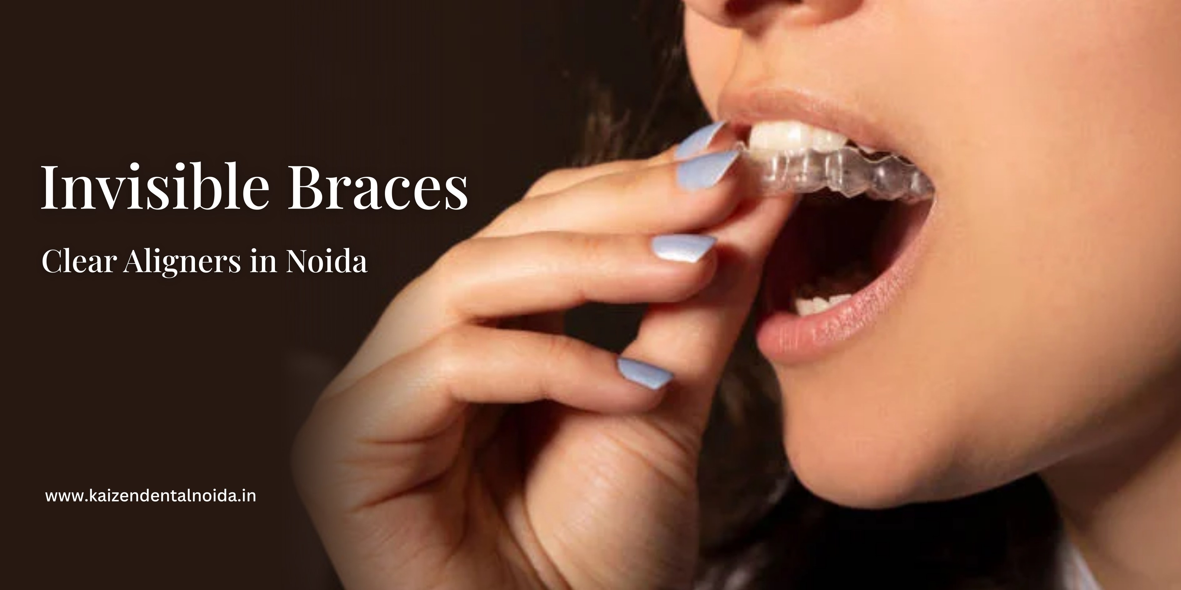 invisible-braces-in-india-kaizen-dental-clear-aligners-noida-best-invisalign-dentist