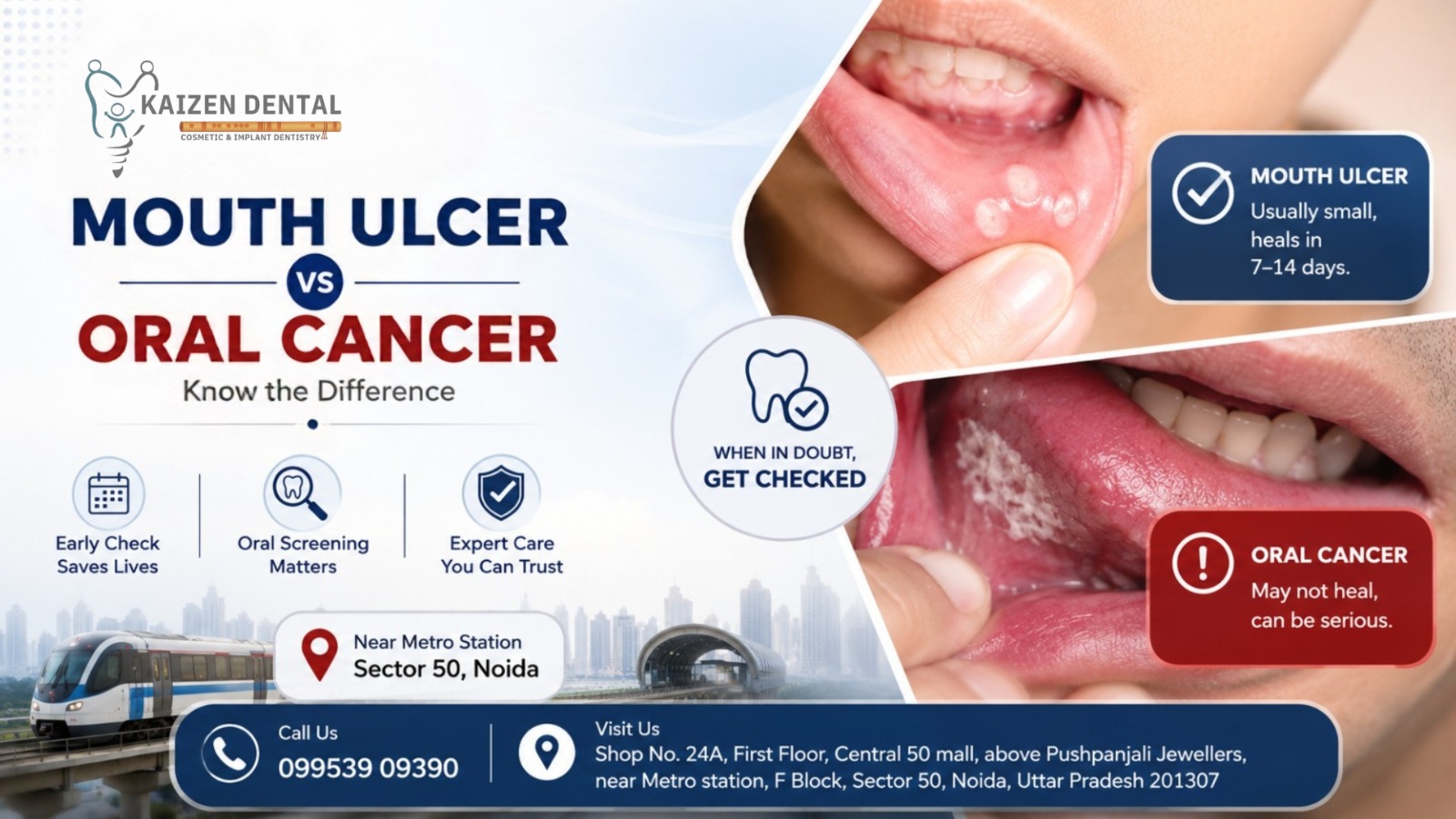 mouth-ulcer-vs-oral-cancer-difference-warning-signs-Noida-Sector-50-oral-screening-kaizen-dental-near-metro