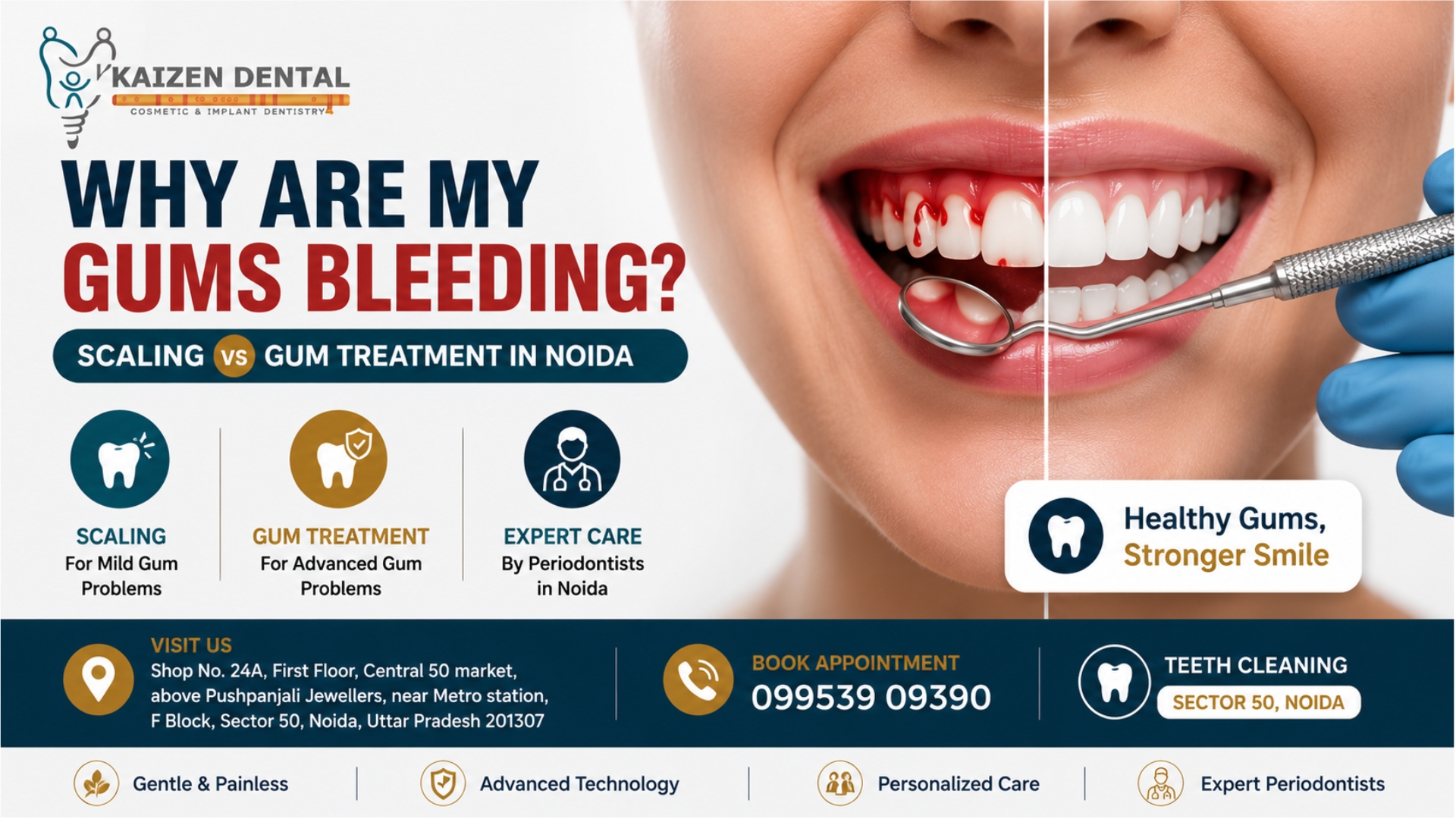bleeding-gums-treatment-Noida-periodontist-Sector-50-scaling-gum-disease-kaizen-dental-central-50-market-near-metro