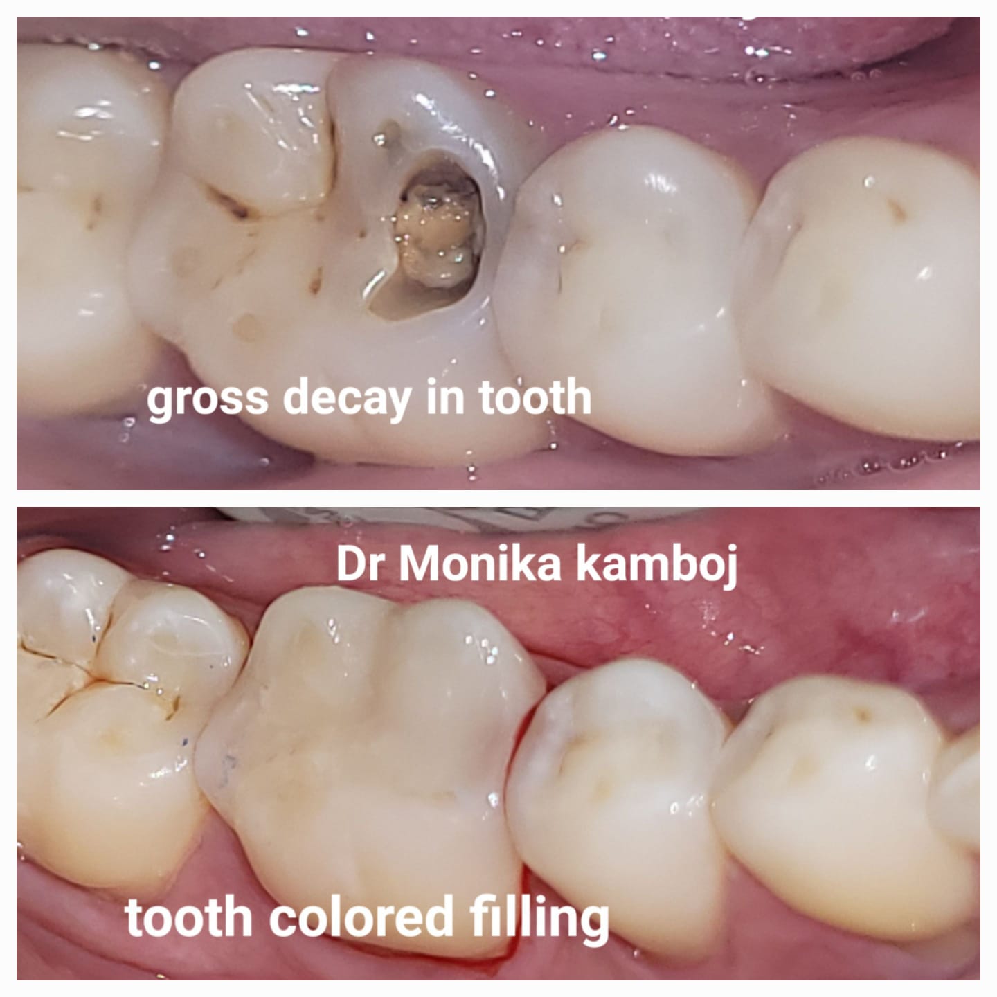 Composite Restoration Tooth Coloured Filling