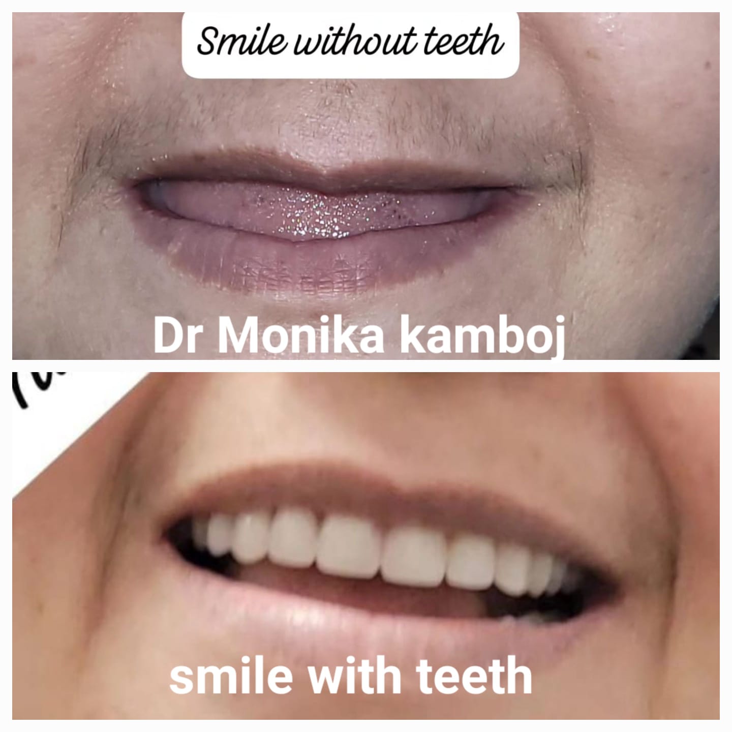 Implant Overdenture Result