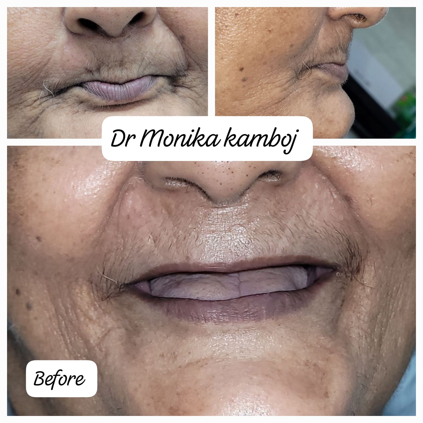 Complete Denture Case