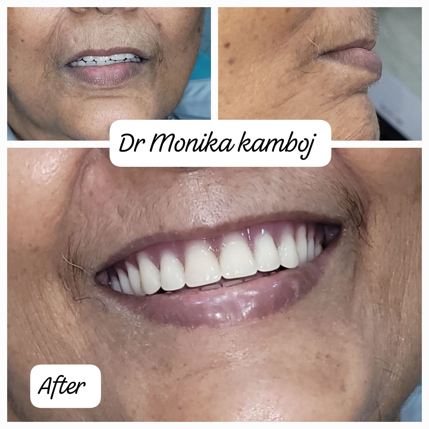 Implant Supported Lower Denture