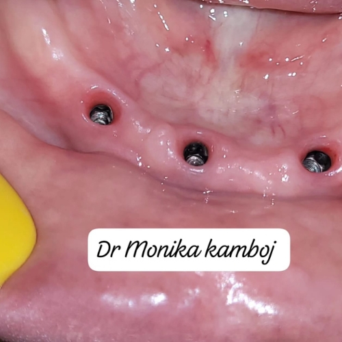 Full-mouth-rehabilitation-treatment-sec-78-noida-at-kaizen-dental-clinic