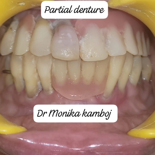 Full-mouth-rehabilitation-treatment-sec-78-noida-at-kaizen-dental-clinic