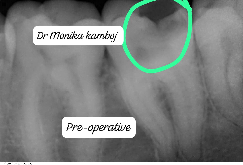 Tooth with severe pain before RCT