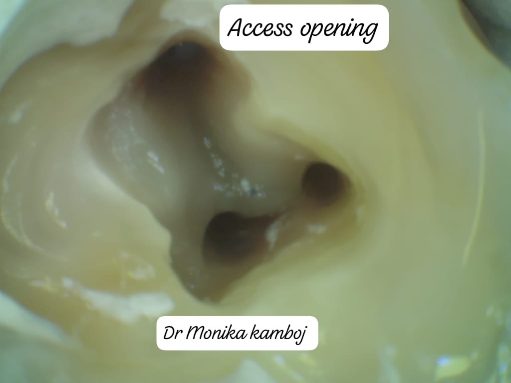 Root canal cleaning and shaping