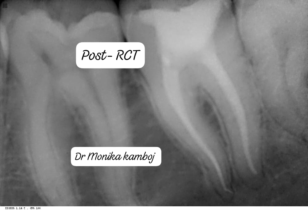 Post RCT restoration