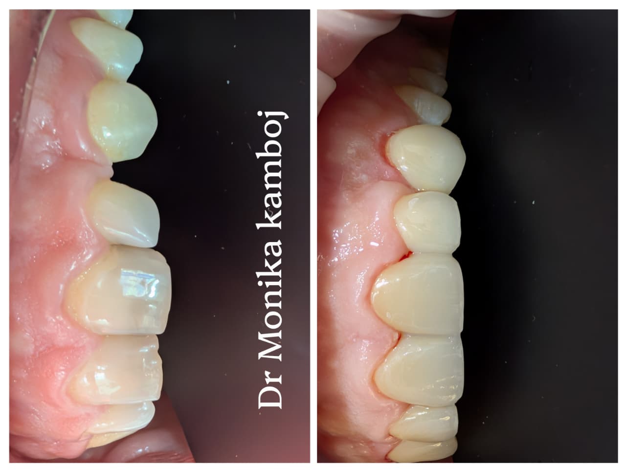 Smile Designing Before Veneers