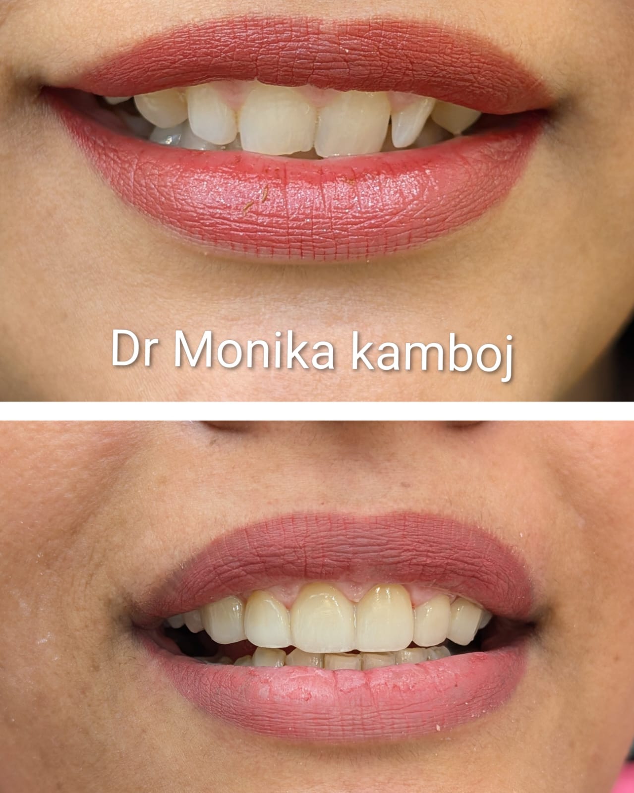 Smile Designing After Veneers