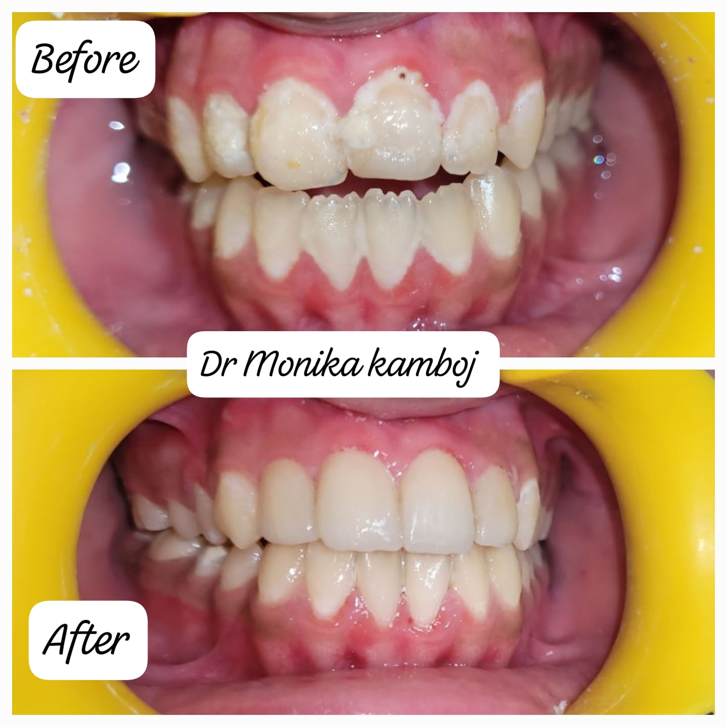 Smile Designing with Ceramic Veneers