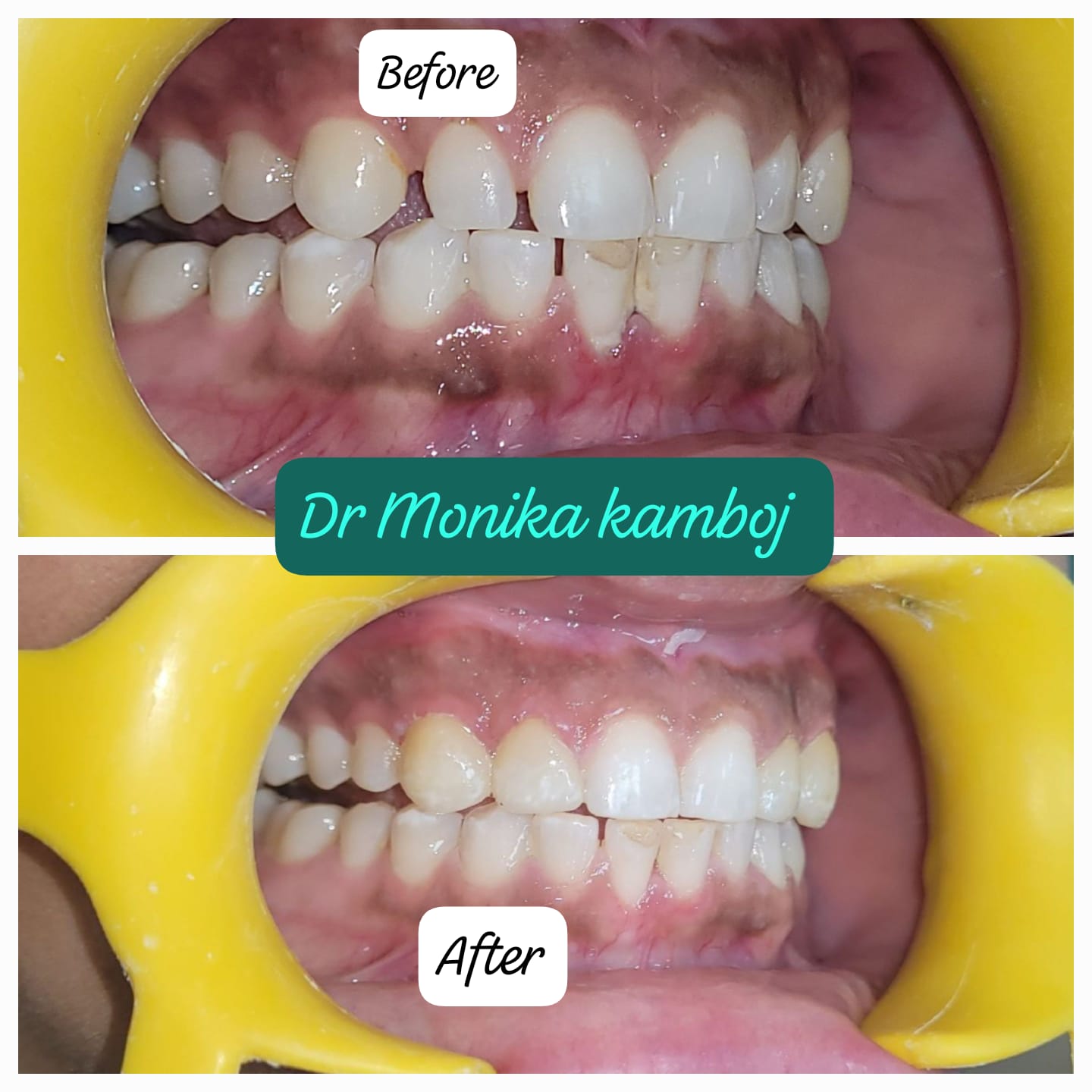 Smile Designing Before Veneers