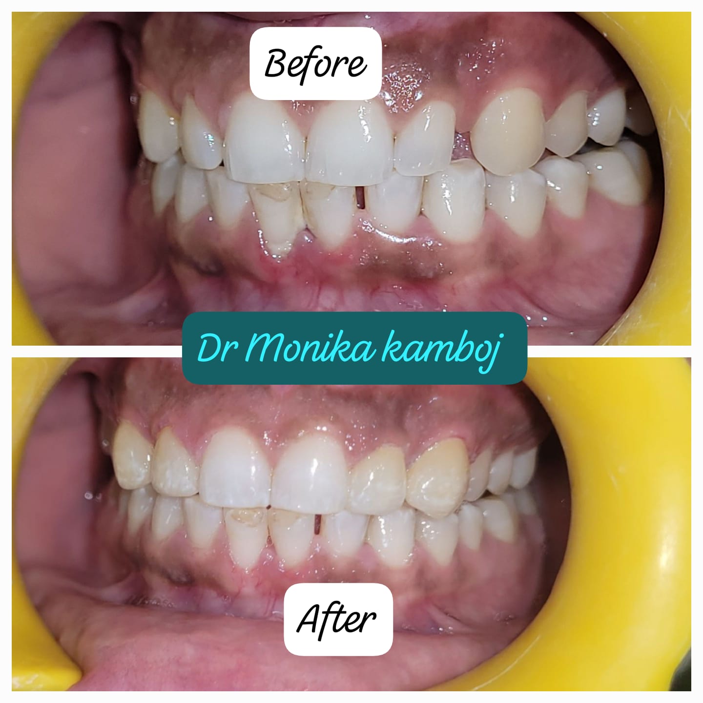 Smile Designing After Veneers